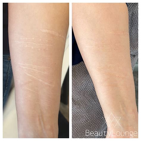 Voor En Na Fotos Medische Tatoeage Beauty Lounge
