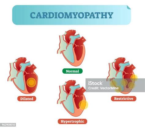 Cardiomyopathy Medical Disorders Cross Section Diagram Vector