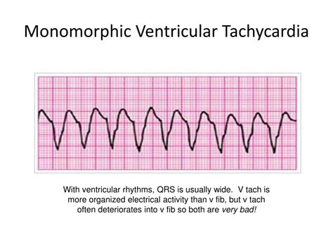 Acls Rhythm Cheat Sheet