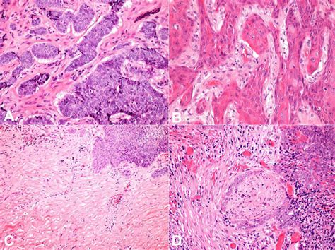 A Photomicrographs Of The Tumor Showing The Basal Cell Carcinoma