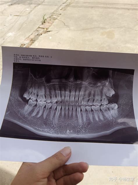 我第二次拔智齿的经历 知乎