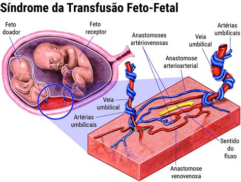 Sindrome De Transfusion Feto Fetal Todaygetty