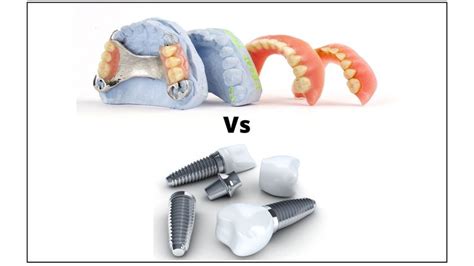 Tooth Loss Can Be Very Distressing Indeed And Can Hamper Not Only Ones