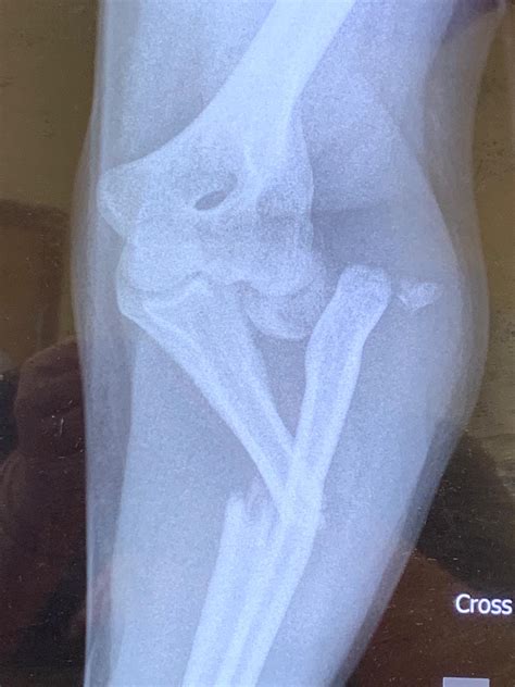 Until last Tuesday I had never broken a bone and then I decided to