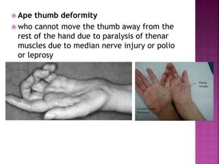 ape thumb deformity  publish pptx