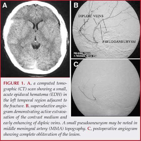 Epidural Hematoma Middle Meningeal Artery