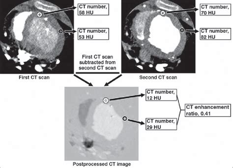 Examples Of Calculation Of Ct Enhancement Ratio Using Data From Ct Scan