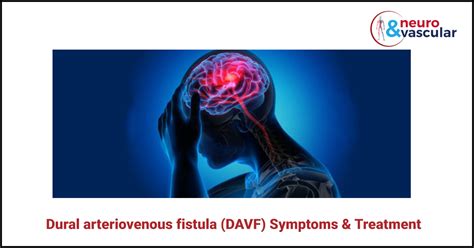 Congenital Av Fistula
