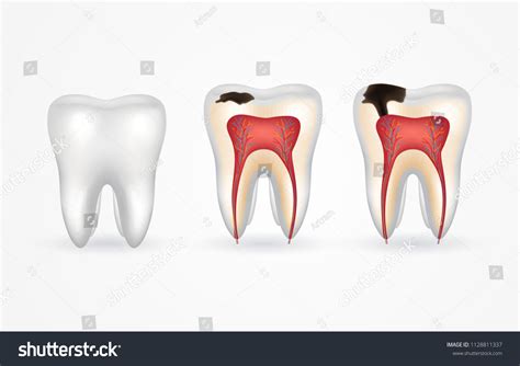 Stages Of Tooth Decay Over Royalty Free Licensable Stock Vectors