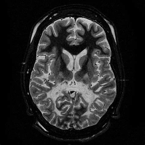 Adrenoleukodystrophy Neurology Medbullets Step 2 3