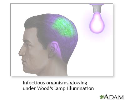 Top 25 of Woods Lamp Test | nogalinatiesapni