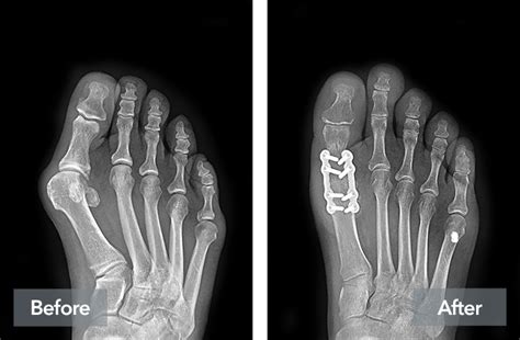 Limitations After Big Toe Fusion UKZFM