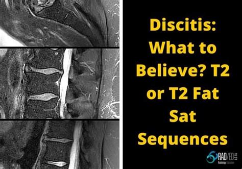 Early Discitis : Which scan to believe? - Radedasia
