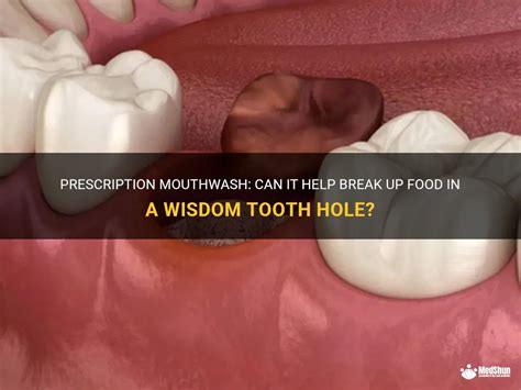 Prescription Mouthwash Can It Help Break Up Food In A Wisdom Tooth