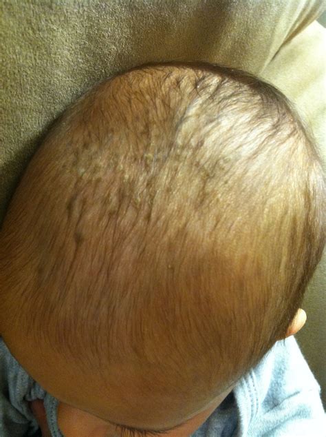 how to fix cradle cap