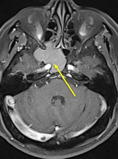 Mucocele Radiology Cases