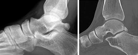 Talus Avulsion Fracture