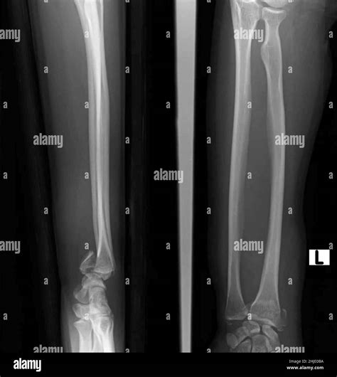 Smith fracture, X-ray Stock Photo - Alamy