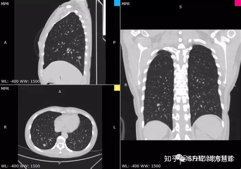 读懂肺结节（二）：肺结节的相关影像检查 知乎