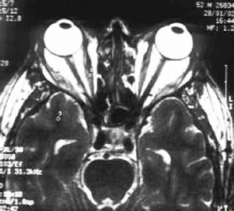 Shows axial MRI image at T2 to evaluate lateral and medial rectus ...