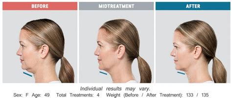 Kybella Cost Prices List For Double Chin Reviews