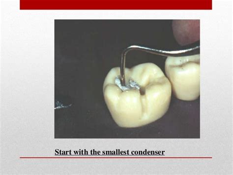 procedure for amalgam restoration