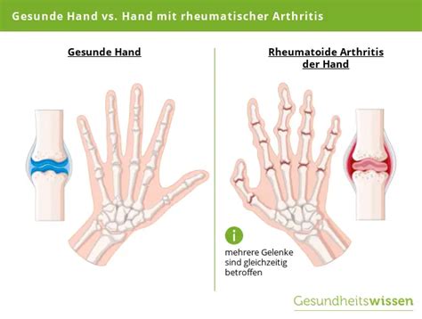 Diagnose Rheuma Alles Zu Ursachen Symptome Behandlung