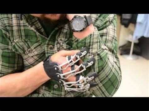 Youtube Advanced Bionics Hands Amputee