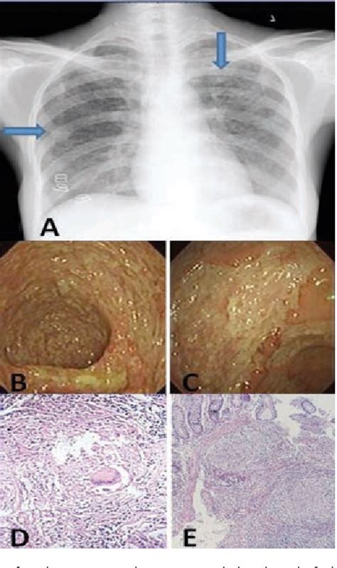 Figure 1 From Severe Pulmonary Tuberculosis Complicating Intestinal