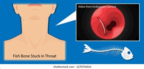 Fish Bone Stuck Throat Stock Vector (Royalty Free) 1270754314 ...