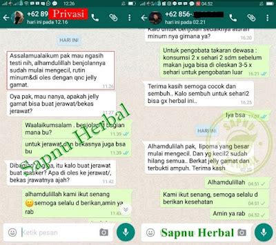 Tanpa Operasi Begini Cara Menghilangkan Lipoma Secara Alami Katenzo