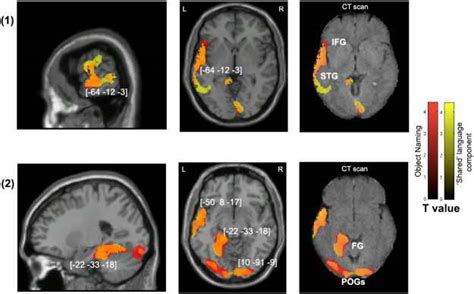 Voxel Wise Statistical Analysis Of Grey Matter Damage Overall Object