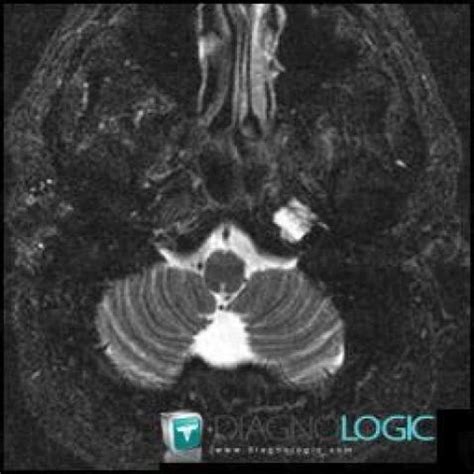 Radiology case : Petrous apicitis (MRI) - Diagnologic