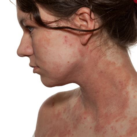 Want To Get To The Bottom Of Your Eczema Skin Flare Up The Clinic