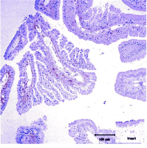 Testicular Mesothelioma From Shark No 3 Stained With The Anti Ras