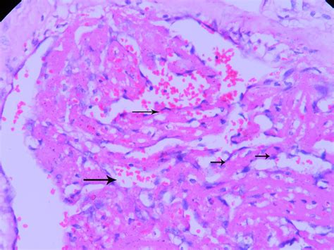 Organizing Thrombi Histopathology Guru