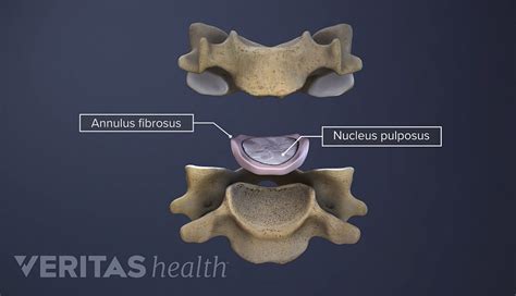 Spinal Discs | Spine-health