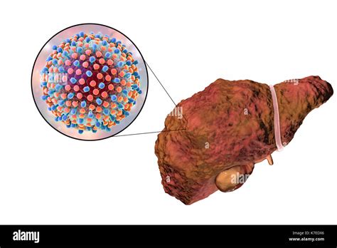 Cirrosis Del Higado Vs Higado Sano