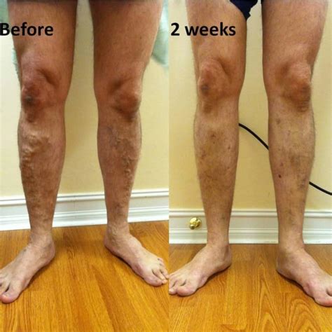 List 93 Pictures Varicose Veins Images Legs Updated