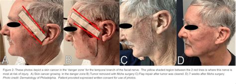 Facial Skin Cancer Important Areas To Catch Early