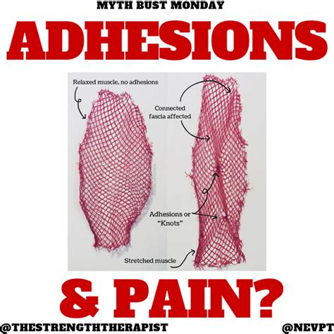 Myth Busting Adhesions — Physio Network