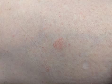 Discoid rash? : r/lupus