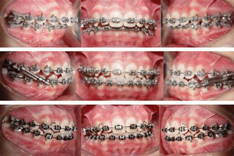 Photographs Before During And After Having Used The Protruding Download Scientific Diagram