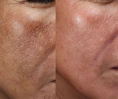 Melasma Pima Dermatology