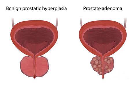 Adenoma And Benign Prostatic Hyperplasia Photograph By Veronika