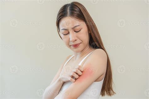Dermatology asian young woman, girl allergy, allergic reaction from