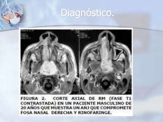 Angiofibroma nasofaríngeo juvenil PPT