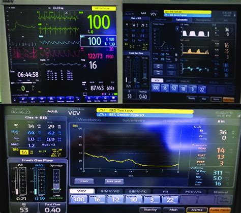 Showing The Low Bis Values Corresponding Hemodynamics And Respiratory Download Scientific