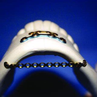 parallel plates pp  scientific diagram