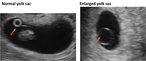 Understanding how 4 abnormal ultrasound findings relate to miscarriage ...